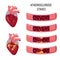 Human heart and Atherosclerosis stages.