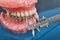 Human jaw or teeth model with metal wired dental braces
