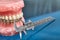 Human jaw or teeth model with metal wired dental braces