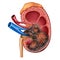 Human Kidney Cancer Anatomy