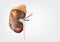 Human Kidney presents  a medical concept as a organ that has the formation of painful minerals as a medical symbol with visual