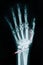 Human Left hand on device x ray.