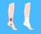 Human leg injury