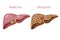 Human liver, digestive system. Healthy and diseased liver, cirrhosis. Vector illustration