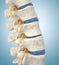 Human lumbar spine model demonstrating thinned disc