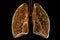Human lungs affected by miliary tuberculosis, 3D illustration