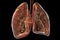Human lungs affected by miliary tuberculosis, 3D illustration