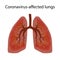 Human lungs damaged by coronavirus covid-19.