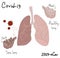 Human lungs with disease.coronovirus pneumonia