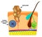 Human Papilloma Virus causes the formation of papillomas on the skin. Structure. Infographics. Vector illustration on