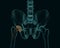 Human skeleton with a metal hip prosthesis concept arthroplasty