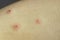 Human skin with scratched pimples. Allergy, dermatitis, virus or bacterial infection. Dermatology, medicine and health care