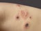 Human skin with scratched pimples. Allergy, dermatitis, virus or bacterial infection. Dermatology, medicine and health care