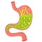 Human stomach. Gastritis and acid reflux, indigestion, vomiting, heartburn and stomach pain problems. Unhealthy stomach concept.