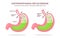 Human stomach. Gastroesophageal reflux disease. GERD, heartburn, gastric infographic. Acid moving up into the esophagus. Vector