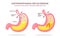 Human stomach. Gastroesophageal reflux disease. GERD, heartburn, gastric infographic. Acid moving up into the esophagus. Vector