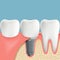 Human teeth and Dental implant. Anatomy of the oral cavity. Stoc