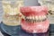 Human teeth orthodontic dental model with implants, dental braces