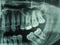 Human teeth xray