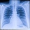 Human thorax x-ray for lungs examination, PA up right. Cancer infected lungs. Virus screening