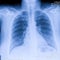 Human thorax x-ray for lungs examination, PA up right. Cancer infected lungs. Virus screening