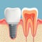 Human tooth in cross-section and dental implant. Stock il