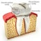 Human tooth, with types of caries (3d model)