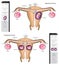 Human Twins Infographic Diagram types identical and fraternal