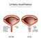 Human urinary bladder, and Urethral bulking procedure with endoscope