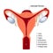 Human Uterus with Endometriosis