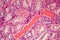 Hyaline degeneration of renal artery