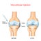 Hyaluronic acid injection for knee osteoarthritis