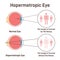 Hypermetropic astigmatism. Hyperopic eye vision with comparison