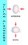 Hyperopia and Hyperopia corrected by a plus lens. Eye vision disorder.