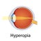 Hyperopia and Vision Disorders Illustration. Eyes Defect Concept. Detailed Anatomy Eyeball with Hyperopia Defect