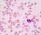 Hypersegmented neutrophil