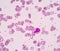 Hypersegmented neutrophil