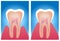 Hypersensitive teeth and normal teeth