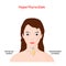 Hyperthyroidism. Woman with thyroid gland