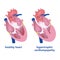 Hypertrophic cardiomyopathy.