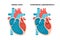 Hypertrophic cardiomyopathy with cross-section view. Human heart muscle diseases. Cardiology concept.