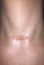 A hypertrophic or keloid scar from a thyroidectomy