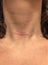 A hypertrophic or keloid scar from a thyroidectomy