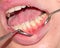 Hypoplasia of tooth enamel