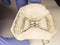 Hyrax braces wear on patient teeth gypsum model