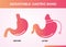 Illustration of Adjustable Gastric Band devise Weight Loss Surgery vector