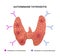 Illustration of the autoimmune thyroiditis. Vector illustration of the antibodies attacking inflamed thyroid gland