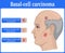 Illustration of Basal cell carcinoma