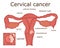Illustration of cervical cancer
