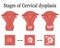 Illustration of Cervical dysplasia